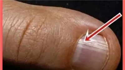 ماذا تعني الخطوط على الأظافر وأسباب ظهورها؟