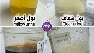 بول شفاف : كثرة شرب…