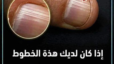 ماذا تعني الخطوط على الأظافر وأسباب ظهورها؟