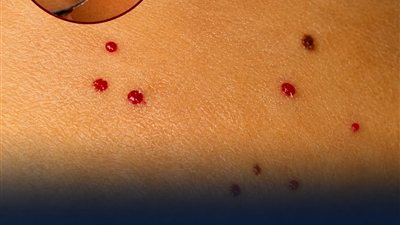 أسباب ظهور نقاط حمـراء على بشرتك.. الطبيب يكشف معناها المحتمل