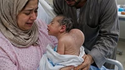 ابني اتولد بحدب شديد ووش مميز