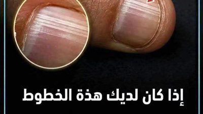 ماذا يعني الخطوط على الأظافر