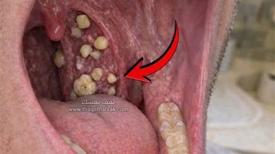 الحصوات البيضاء الصغيرة في الفم لماذا رائحتها كريهة؟ وكيف تتكون؟ وعلاجها طبيعياً