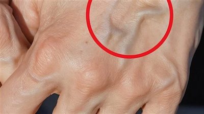 العروق البارزة في اليدين تبابها وعلاجها وطرق تقليل مظهرها