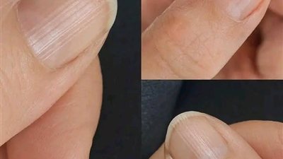 وجود أظافر مخططة قد يعني أن جسمك..