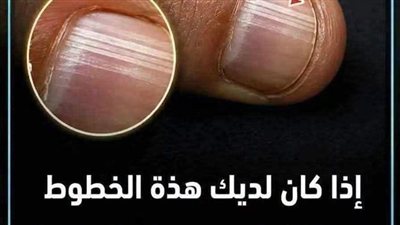 ماذا يعني الخطوط على الأظافر