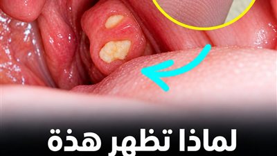 الحصوات البيضاء الصغيرة في الفم لماذا رائحتها كريهة؟ وكيف تتكون؟ وعلاجها طبيعياً