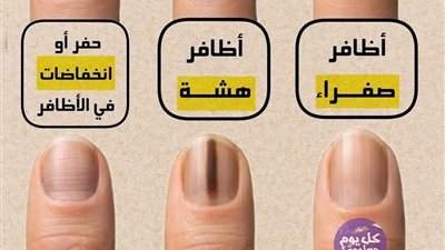  أظافر صفراء داء سكري قصور الغدة الدرقية